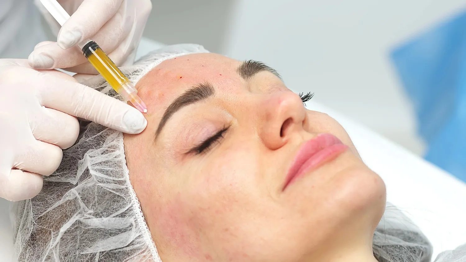 Woman receiving a platelet-rich plasma (PRP) facial treatment at Divine Age Med Spa in Wesley Chapel, FL.